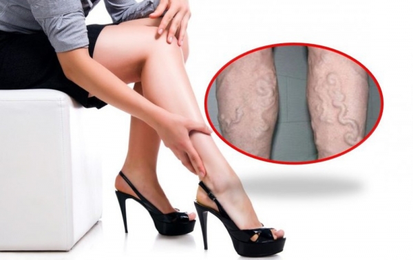 10 lời khuyên của bác sĩ giúp phòng bệnh suy giãn tĩnh mạch